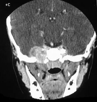 Rhabdomyosarcoma